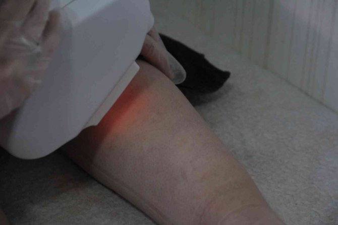 Lazer Kadının Vücudunu Yakmıştı, Başka Bir Güzellik Uzmanı Tedavisini Üstlendi