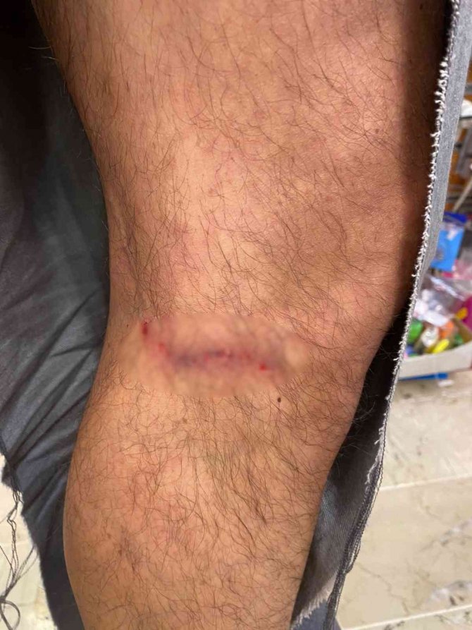 Çankaya’da Başıboş Köpekler Vatandaşın Kıyafetlerini Parçaladı