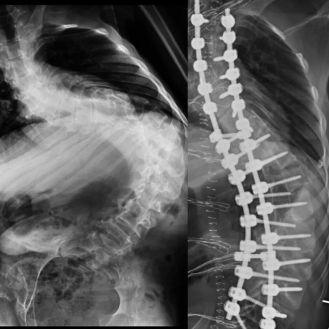 İ̇leri Derecede Skolyozu Olan Çocuk, 9 Saatlik Operasyonla Sağlığına Kavuştu