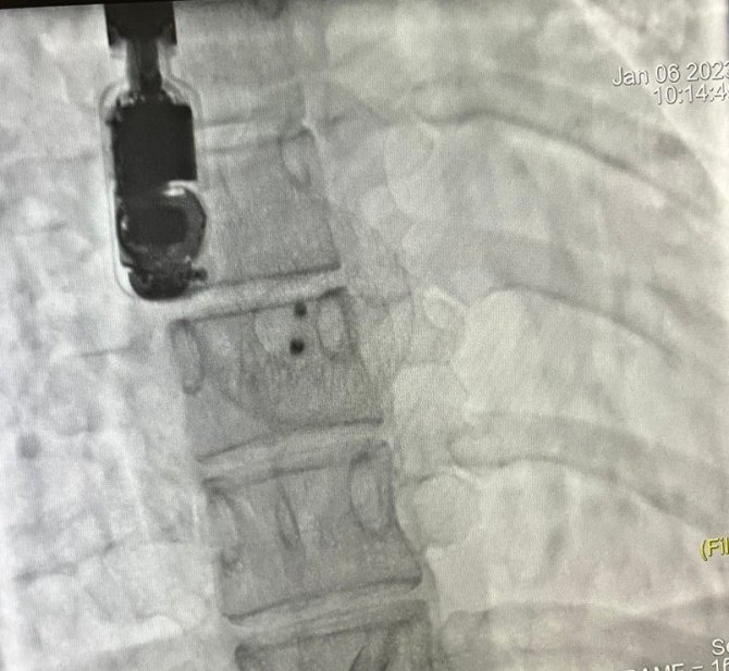 Kalbi Delik Hasta, Ameliyatsız Kapama İşlemiyle Sağlığına Kavuştu