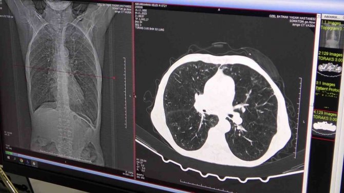 Uzman Doktor, Radon Gazı Tehlikesine Karşı Vatandaşları Uyardı