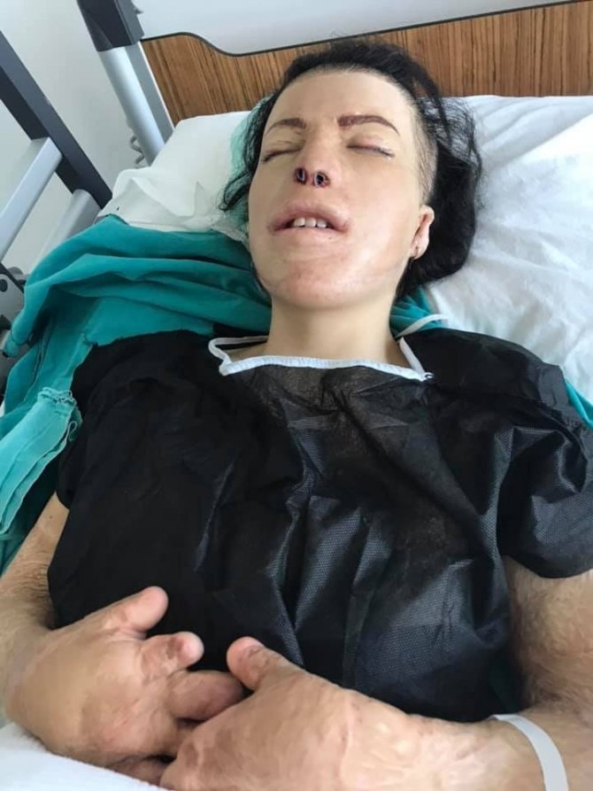47 Kez Ameliyat Oldu, Yeni Yüzüne Kavuştu