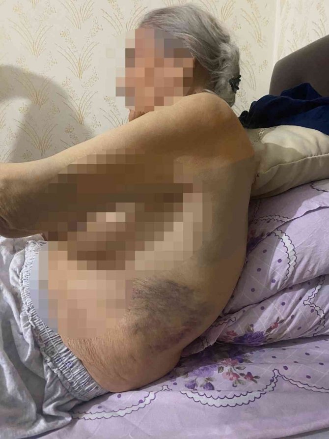 Ankara’da Bakıcı Dehşeti: 91 Yaşındaki Yaşlı Kadın Hastanede Ölüm Kalım Savaşı Veriyor