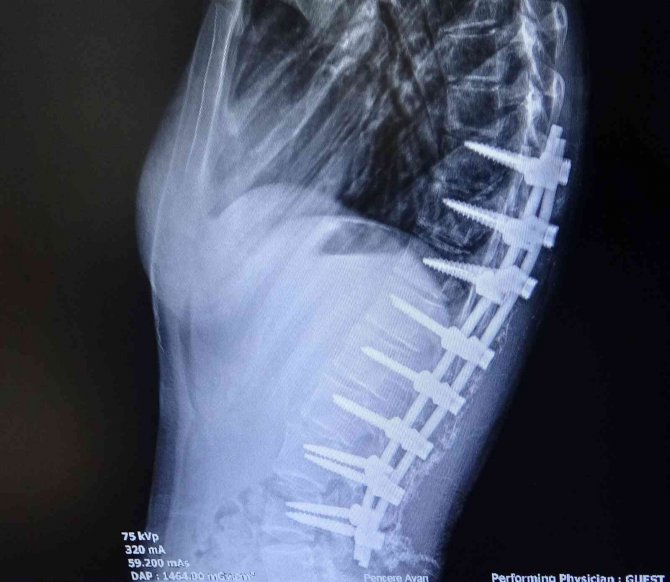Doğuştan Skolyoz Hastası Genç Kız, İkinci Ameliyatla Sağlığına Kavuştu
