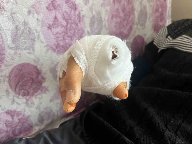 Komşusunun Köpeğinin Saldırısına Uğrayan Vatandaşın Parmağı Koptu, Eli Parçalandı
