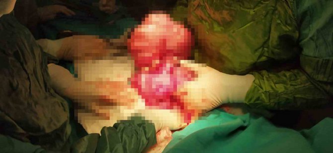 Kilo Aldığını Sanıyordu, Karnından Çıkanlar Görenleri Şaşırttı