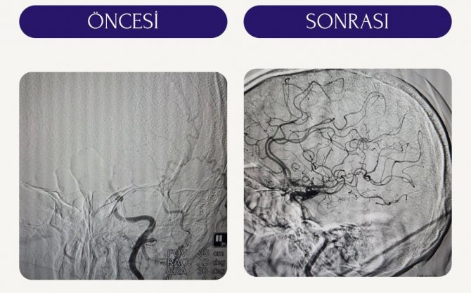 İ̇nme Geçiren Hastalara Trombektomi Tedavisi
