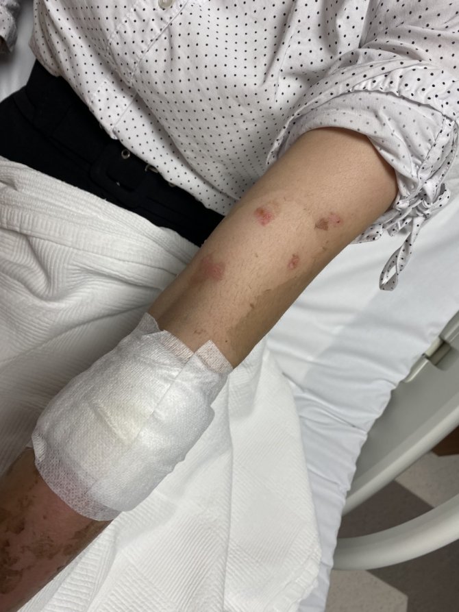 Lavabo Açıcı Bomba Gibi Patladı, Genç Kız: “Kolumdan Vazgeçmiştim, Yüzümden Çok Korktum”