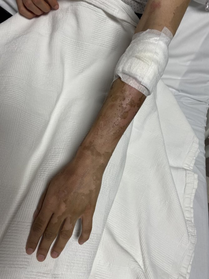 Lavabo Açıcı Bomba Gibi Patladı, Genç Kız: “Kolumdan Vazgeçmiştim, Yüzümden Çok Korktum”