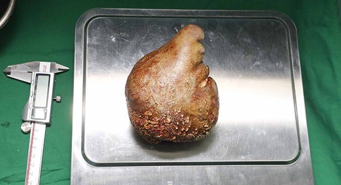 Sri Lanka’da Dünya Rekoru: 801 Gram Ağırlığında Böbrek Taşı Çıkarıldı
