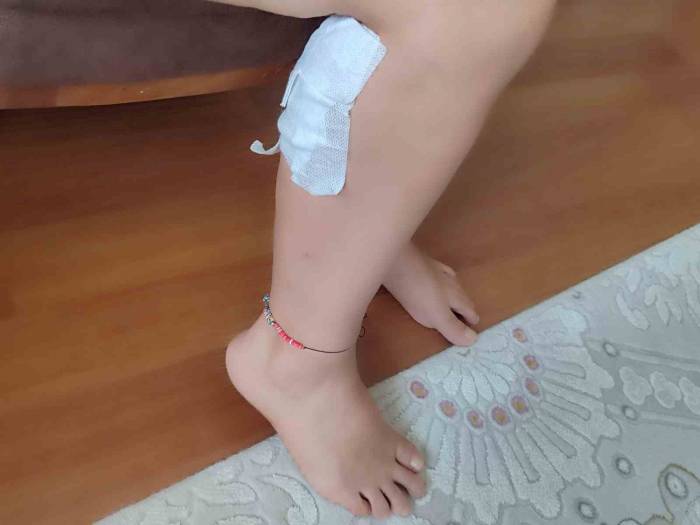 Sokak Köpeğini Sevmek İstediği Sırada Köpek Tarafından Saldırıya Uğrayan Kadın Bacağından Yaralandı