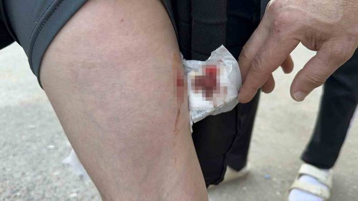 Okula Giderken Sokak Köpeğinin Saldırısına Uğradı