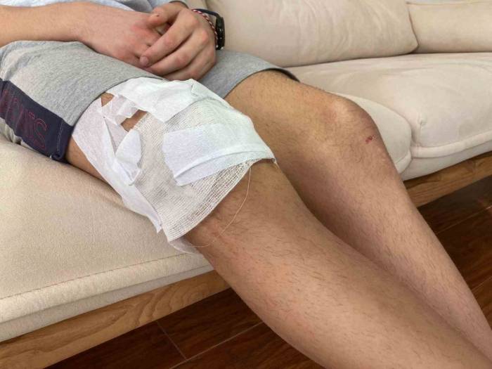 Köpek Saldırısına Uğrayan Çocuğun Ailesi, Çankaya Belediyesine Dava Açmaya Hazırlanıyor