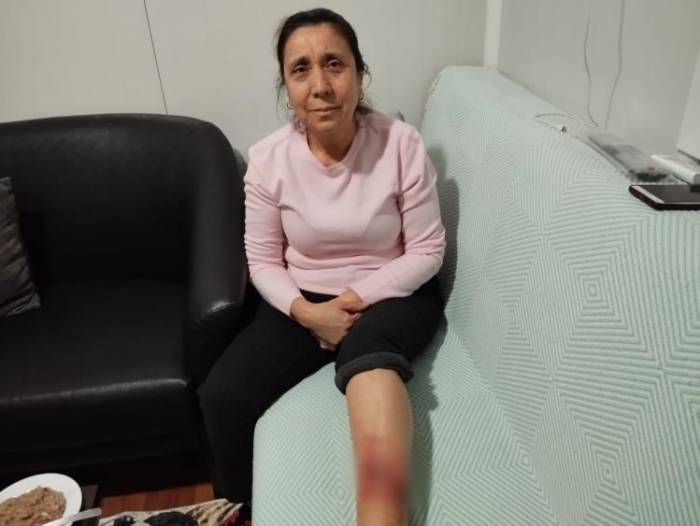 Köpek Saldırısına Uğrayan Kadının Bacağında Yarık Oluştu