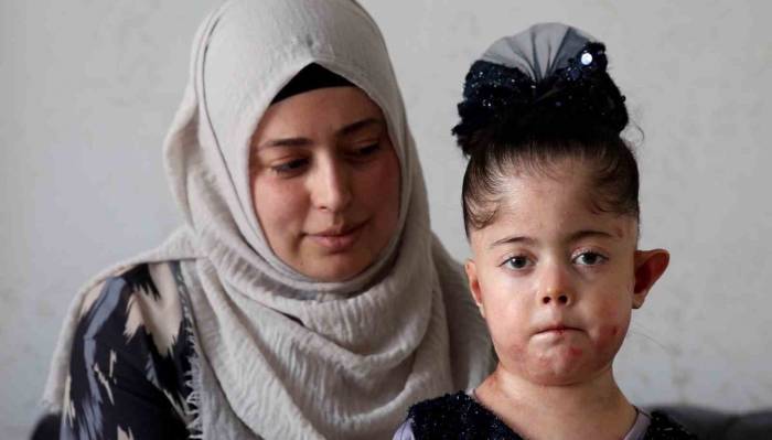 Tek Dileği Kelebek Hastası Kızına Doyasıya Sarılabilmek