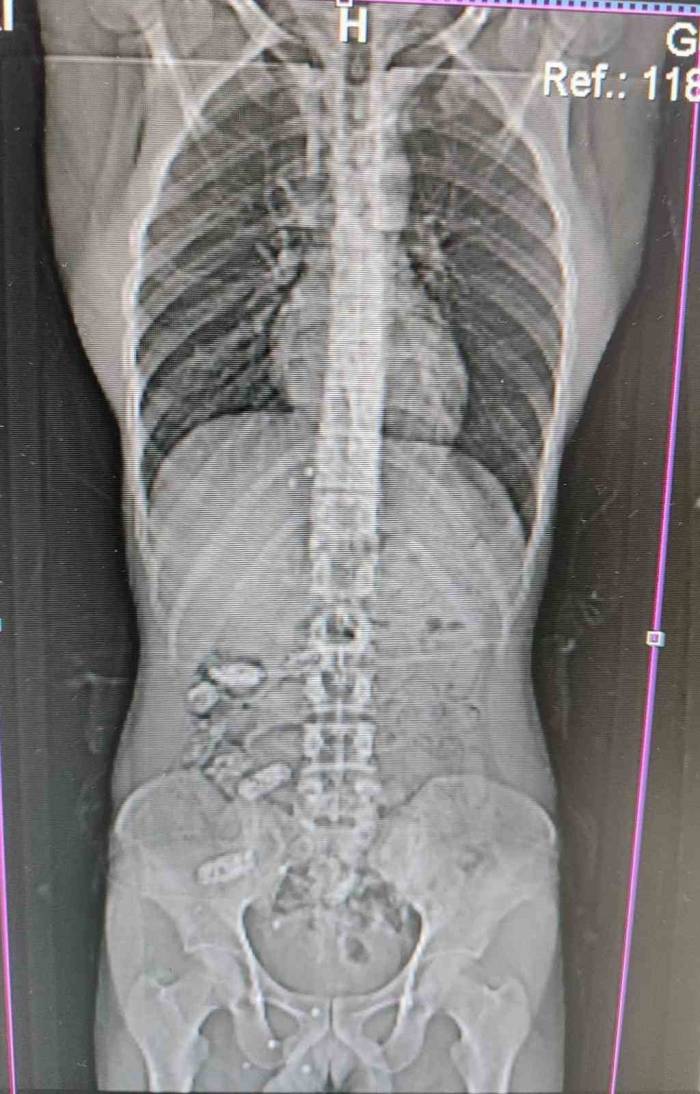 Uyuşturucu Kuryesinin Midesinden 18 Kapsül Çıktı