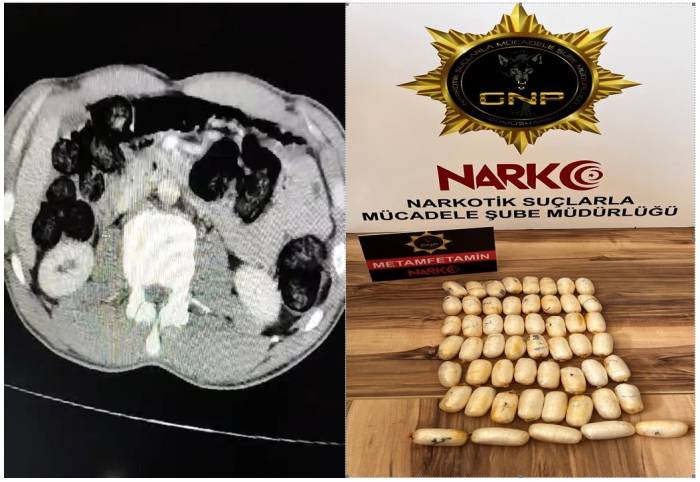 Yabancı Uyruklu Şahsın Midesinden 53 Paket Uyuşturucu Çıktı