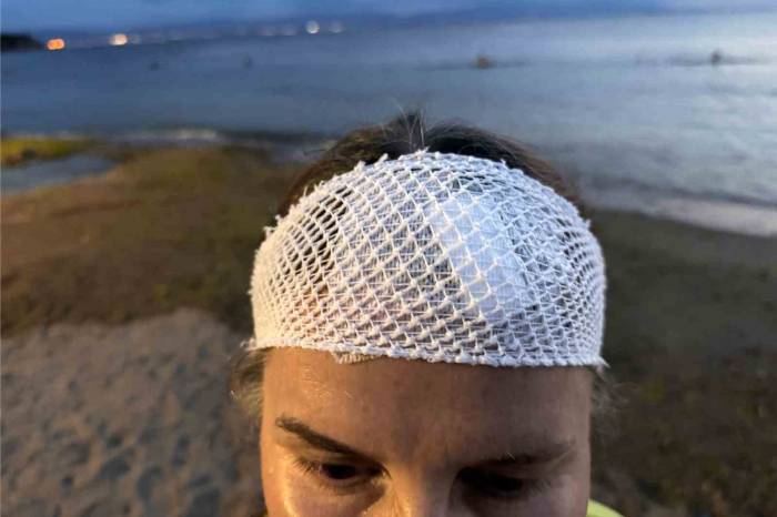 Denizde Yüzerken Jet Ski Çarptı, Ölümden Döndü