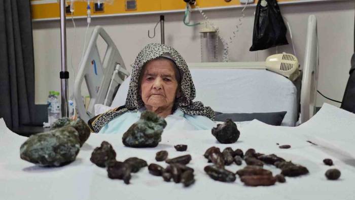 Görenler Şok Oldu: 92 Yaşındaki Kadının Midesinden Ve Bağırsaklarından 35 Zeytin, 28 Hurma Çekirdeği İle 5 Taş Çıktı