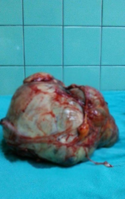 Karnından Basket Topu Büyüklüğünde Tümör Çıktı