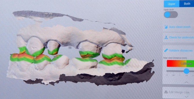 Estetik Dişte Dijital Devir