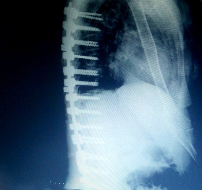 Edremit’te Bir Hastaya Erimeyen Platinden Omurga Yapıldı