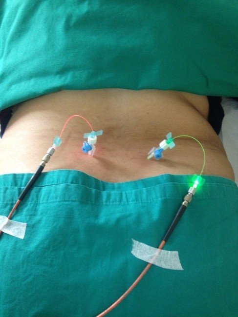 Bel Fıtığında Ameliyatsız Tedavi Dönemi