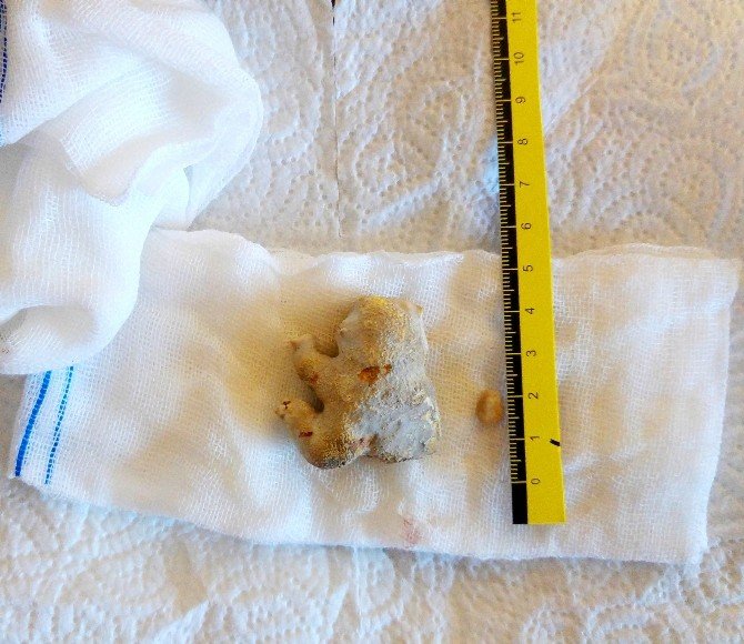 Böbreğinden 4 Buçuk Santimetrelik Taş Çıkartıldı