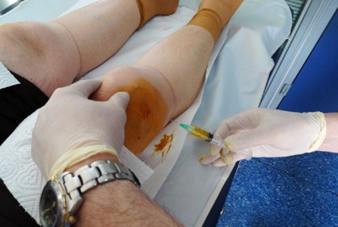 Diz Ağrıları Prp İle Tarih Oluyor