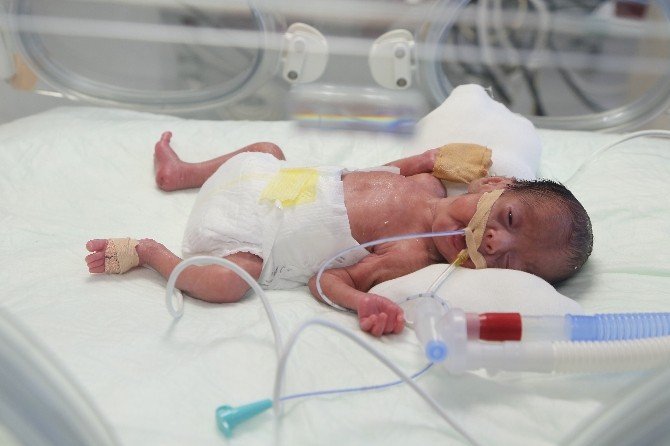 750 Gram Bebeğin Kalbindeki Delik Ameliyatsız Yöntemle Kapatıldı