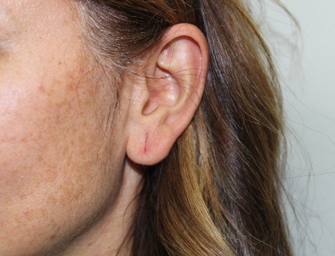 Küçük Yaştaki Kız Çocuklarına Takılan Küpe, Kulak Memesini Yırtabilir