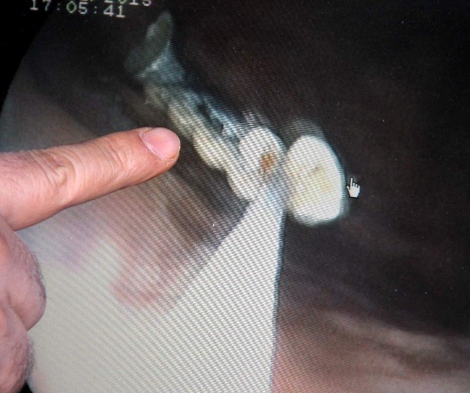 Kaybettiği 5 Dişi Bağırsaklarından Çıktı