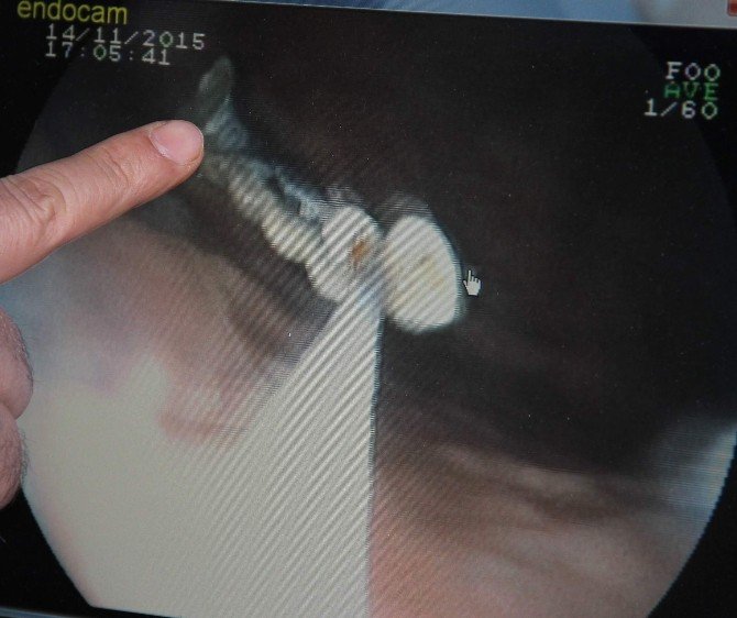 Kaybettiği 5 Dişi Bağırsaklarından Çıktı