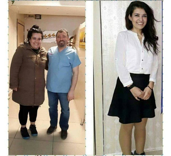 Tip 2 Diyabet Tedavisinde Metabolik Cerrahi İle Büyük Başarı