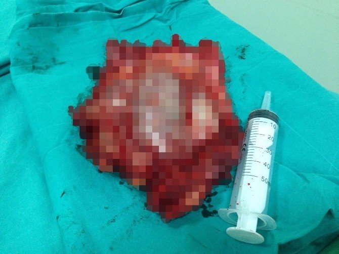 Göğsünden Üç Buçuk Kilo Tümör Çıktı