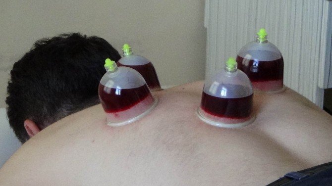 Saç Dökülmesine Hacamatlı Çözüm