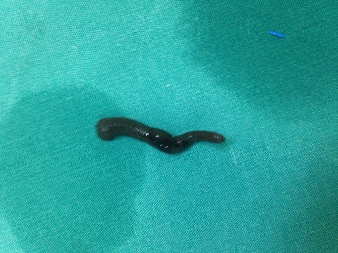 Ses Tellerine Sülük Yapışan Şahıs Ameliyat Edildi