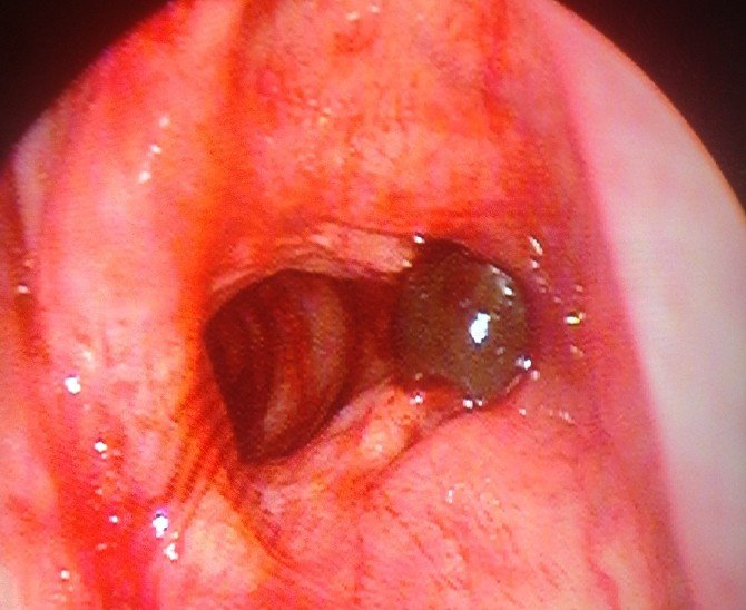Ses Tellerine Sülük Yapışan Şahıs Ameliyat Edildi