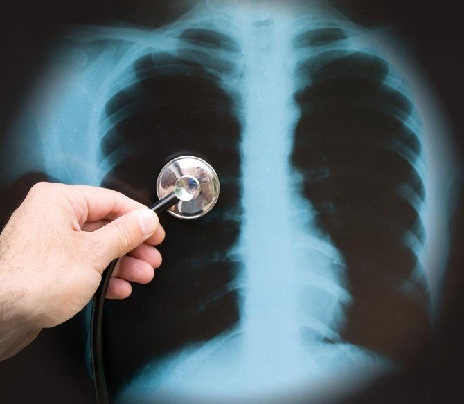 1-5 Yaş Arası Çocuklarda Zatürre Riski 2 Kat Fazla