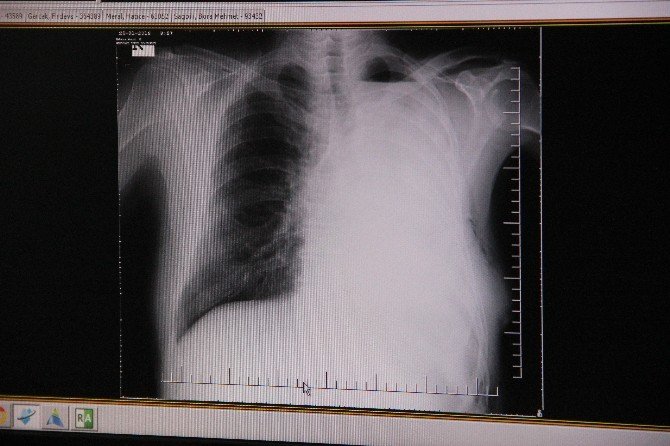 Kalp Zarı Açılarak Akciğeri Alındı