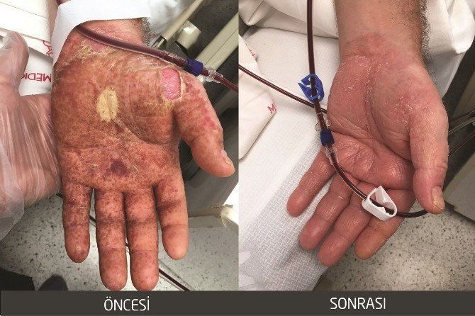 Romatizmal Hasta ‘Aferez Tekniği’ Sayesinde Sağlığına Kavuştu