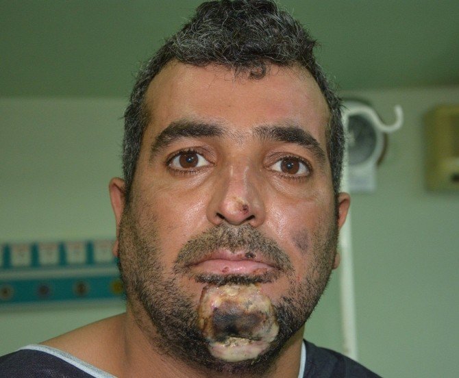 Omuzundan Alınan Dokuyla Çene Yapıldı