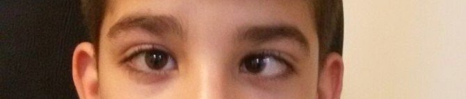 Op. Dr. Yakut: "Şaşılık Her Yaşta Görülebilir"