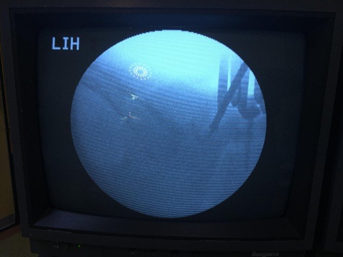 Spinal Stabilizasyon Ameliyatları Hastayı Genel Anestezi Risklerinden Uzaklaştırıyor