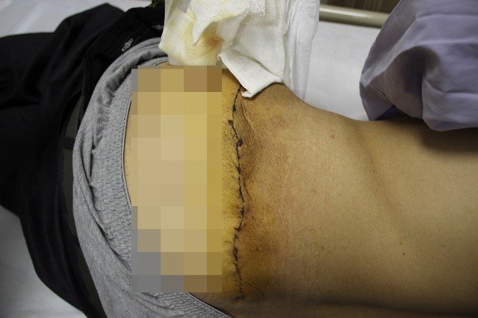 Tümör Nedeniyle 6 Yıl Boyunca Uyuyamadı