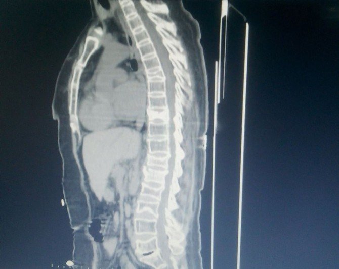 Edremit’te Bir Hastaya Erimeyen Platinden Omurga Yapıldı