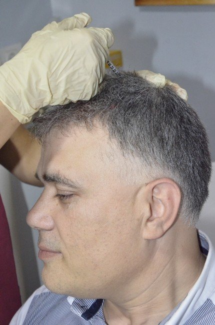 Dökülen Beyaz Saçlara Doğal Tedavi