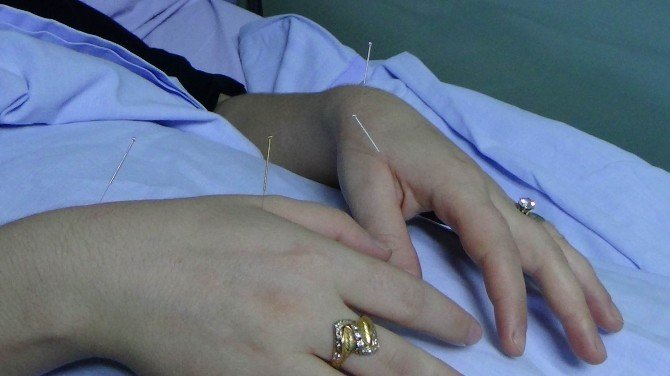 Erkek Kısırlığında Yeni Tedavi Yöntemi: Akupunktur