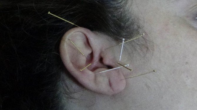 Erkek Kısırlığında Yeni Tedavi Yöntemi: Akupunktur
