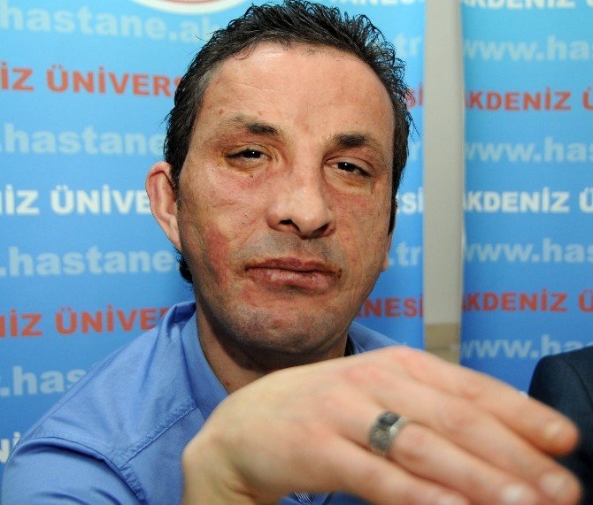 Uğur Acar, Yüz Naklinin 4. Yılında Grip Nedeniyle Hastanede Tedavi Görüyor